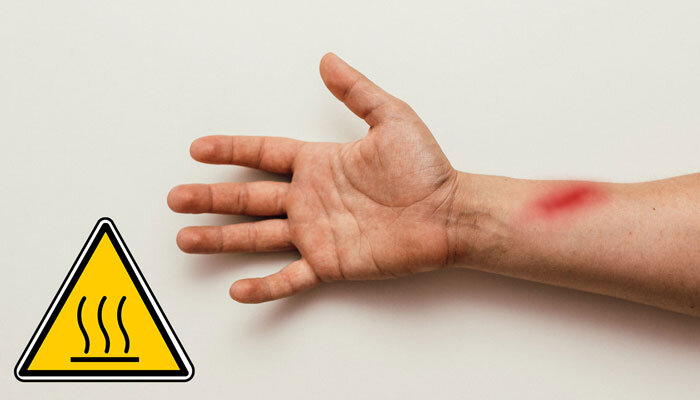  Was tun bei Brandwunden? - 
